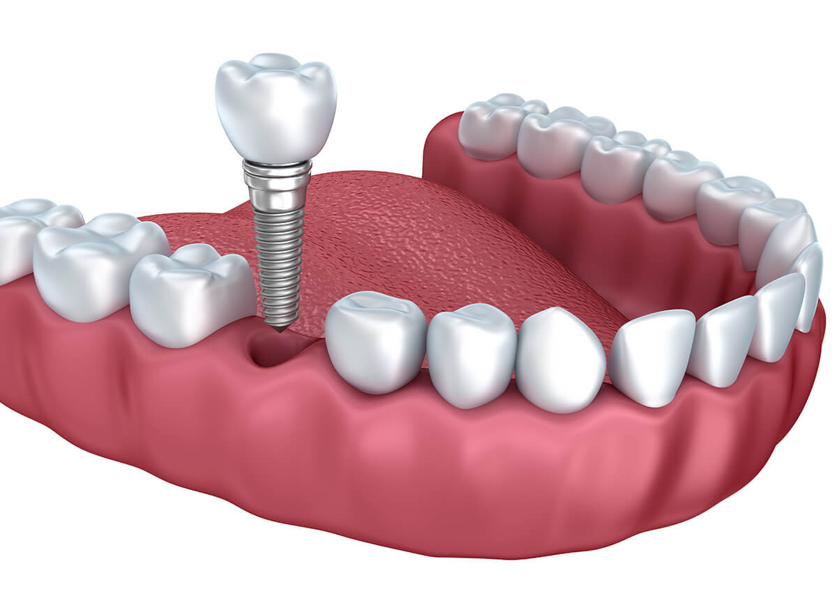 Dental Implants